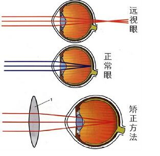 什么是远视眼?