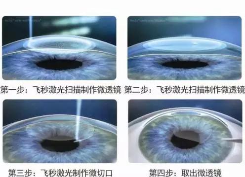 全飞秒SMILE手术在美国正式通过FDA认证