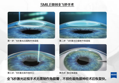 全飞秒近视激光矫正手术近视效果好嘛？