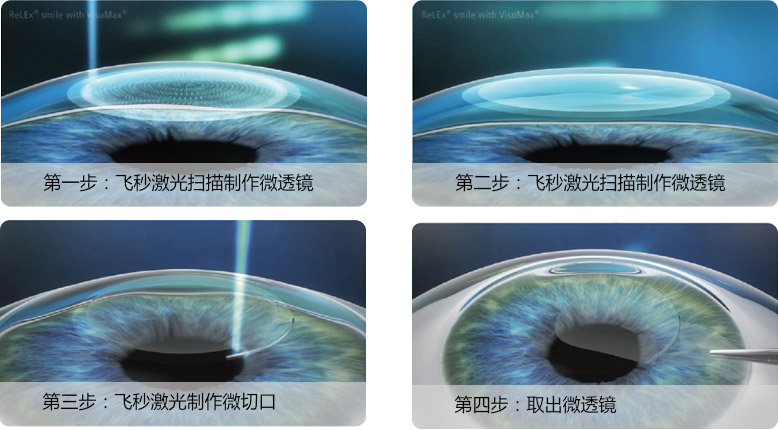 新晚报、生活报报道：普瑞 叁·11近视手术节 全飞秒直降5000