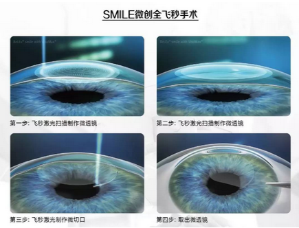 近视激光手术医院哪家好？