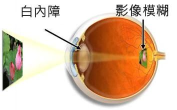 退休工人白内障患者的复明之路