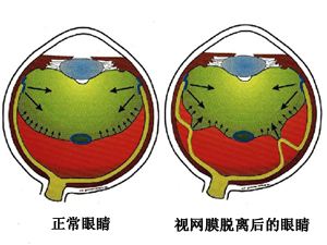 视网膜脱离的症状及方法