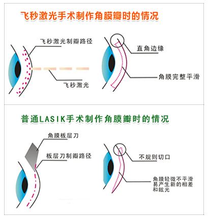 眼睛散光是怎么回事?普瑞眼科专家解析散光