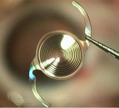 1+1>2，飞白+三焦晶体：解锁高清无镜体验